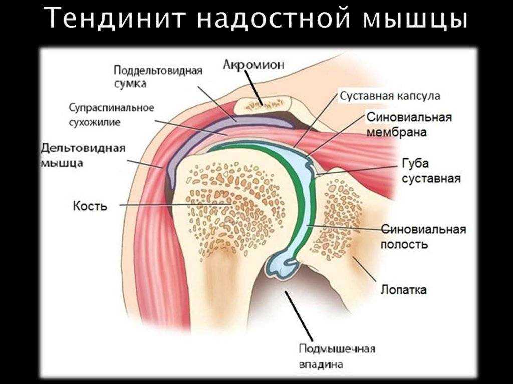 Внутренний импинджмент-синдром плечевого сустава