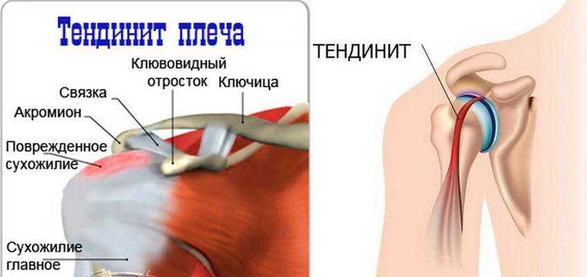 Мягкая мышца при напряжении бицепса это состояние характеризующееся болезненным ощущением и ограничением движения в районе бицепса Это одно из