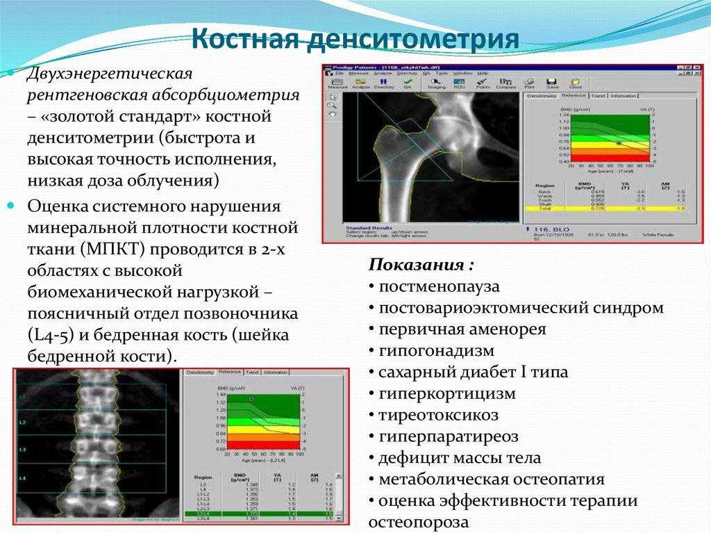 Остеопороз: симптомы, факторы риска, диагностика и лечение заболевания скелета
