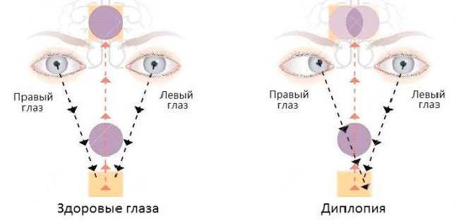 Помутнение в глазах | glaziki.com
