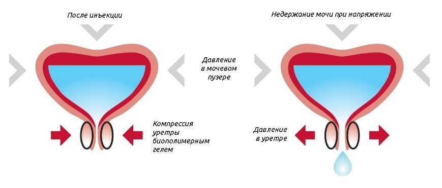 Какие мероприятия проводить при задержке мочи в послеоперационном периоде: рекомендации и советы